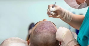 How Does Hair Transplant Work